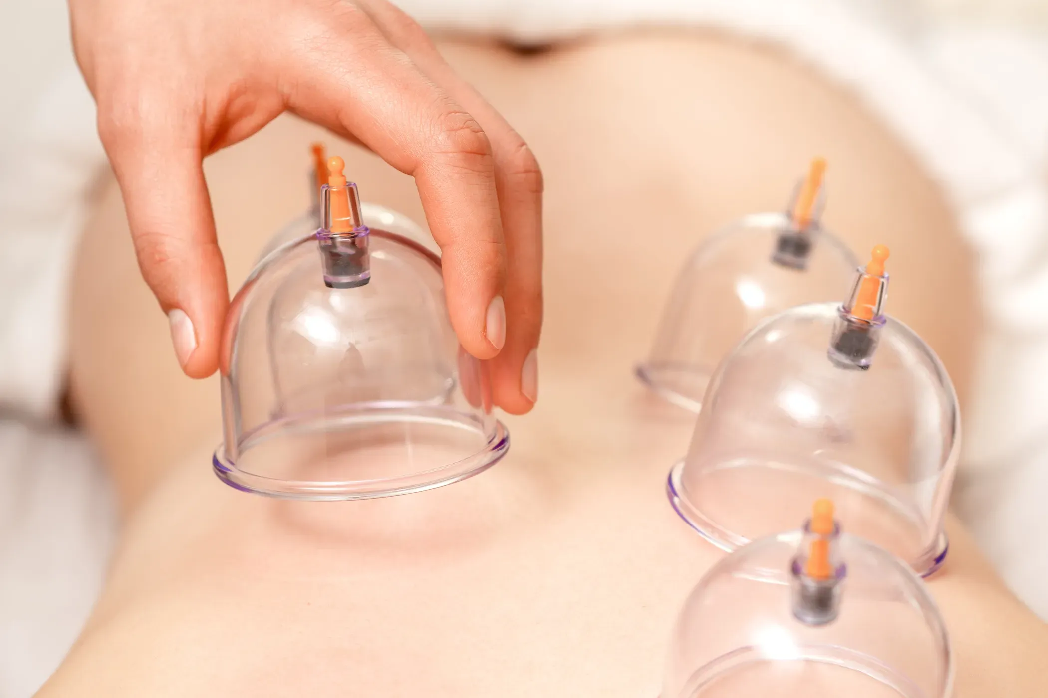 Acupuncture Cupping